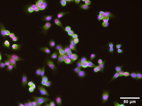 Atypical teratoid rhabdoid tumor cells under a microscope.
